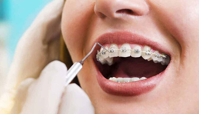 ceramic-braces-common orthodontic problems3