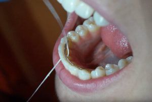 use Super Floss floss in orthodontics
