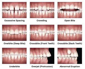 orthodontic-bite-problems