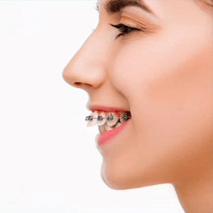 over bite-Overbite-treatment
