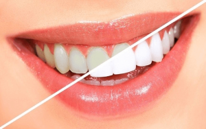 Bleaching and teeth whitening
