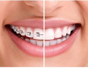 Braces Orthodontic composite veneer