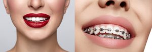 Braces Orthodontic composite veneer.