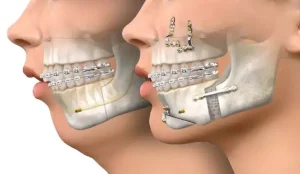 Changes that occur after orthognathic-jaw surgery