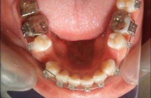 Extracted teeth in orthodontics