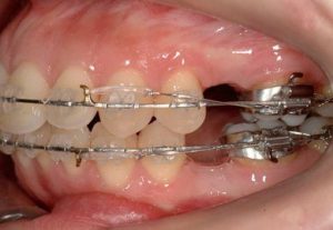 Extraction of teeth during orthodontics