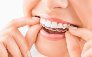 Invisible Invisalign
