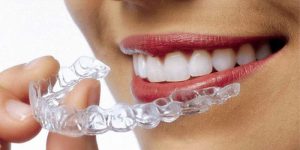 Invisible orthodontics