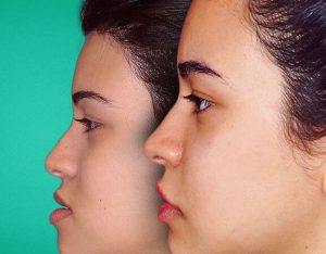 Jaw shape change after surgery