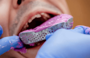 Molding of teeth