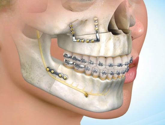 OrthognathicSurgery