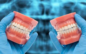 Partial Full Arch Implant Molding of teeth
