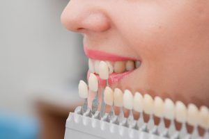 The Difference Between Porcelain and Cosmetic Veneers