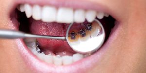 The effect of oral health on lingual Braces orthodontic.