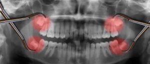 The right time to pull wisdom teeth