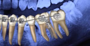 Wisdom teeth in orthodontics