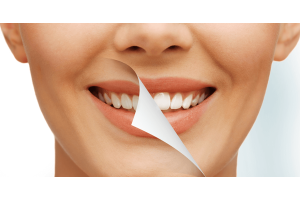 cosmetic dentistry Home Bleaching