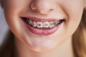 fixed bracket orthodontics