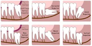 impacted wisdom teeth braces and smiles invisalign orthodontist