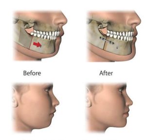 retruding lower jaw surgery