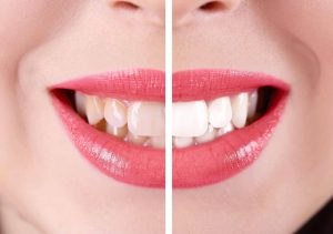 whiteing-Composite veneer