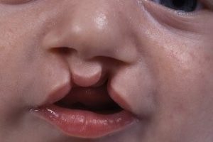Bilateral cleft lip