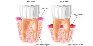 Bone loss around the tooth