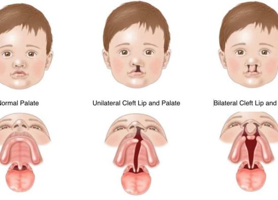 Cleft Lip and Palate Calgary Orthodontist