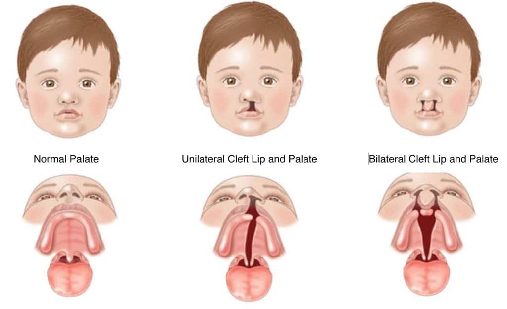 Cleft Lip and Palate Calgary Orthodontist