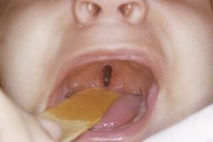 Cleft palate without cleft lip