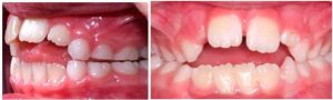 Disturbance of teeth due to oral habits