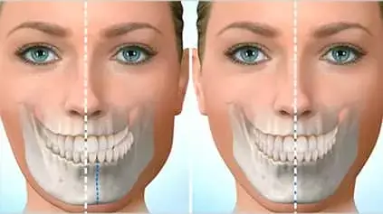 Facial deformity asymmetry and its treatments in orthodontics.