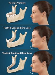 مشکلات لثه و تحلیل استخوان فک(استئولیز فک)