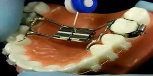 Increasing the width of the palate using an expander