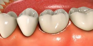 Inflammation of the gums around the teeth