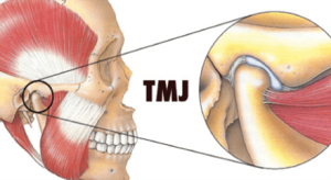 Intertemporal disc protrusion