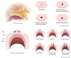 Lip and palate problems and their orthodontic treatments