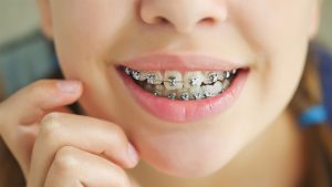 Open bite orthodontic treatment in children