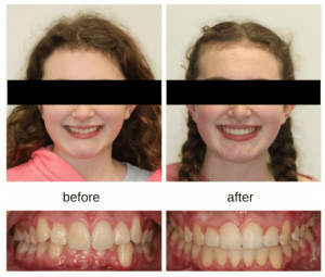 Orthodontic treatment and changing the shape of the lips