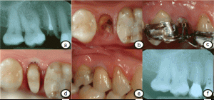 Orthodontic treatment in gum diseases