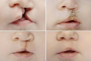 Surgical treatment of cleft lip