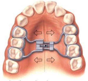 The structure of the jaw expanders