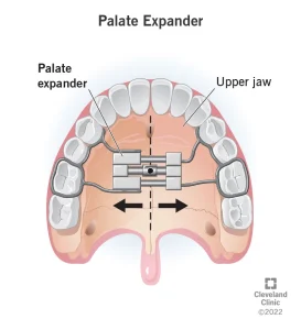 The structure of the jaw palate expanders