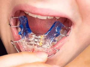 The structure of the jaw palate expanders
