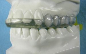 Using a dental guard to reduce wear