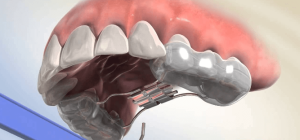 Using orthodontic tools to improve the jaw in people with cleft lip and palate