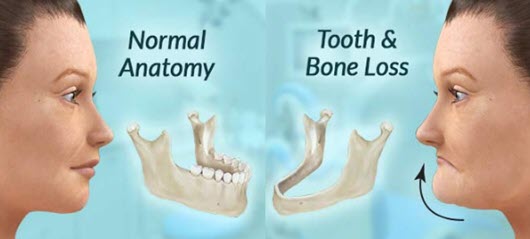 bone deterioration after tooth loss