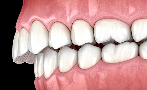 علل بیرون زدگی دندان ها و درمان آن در ارتودنسی