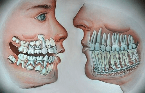 مشکلات فضا در دوره دندان های مختلط