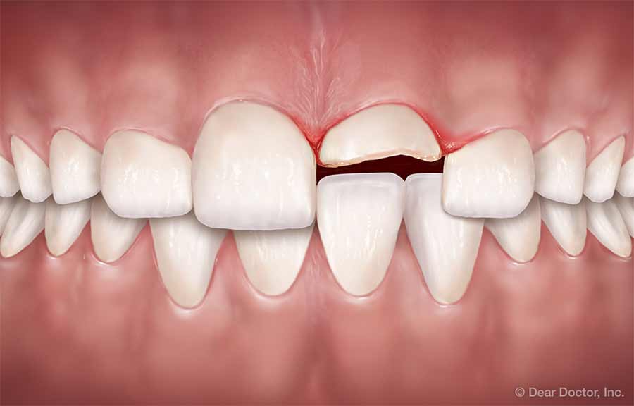 تروما به دندان ها و انواع مشکلات ایجاد شده و درمان آن در ارتودنسی